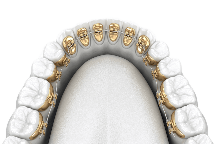 Lingual braces