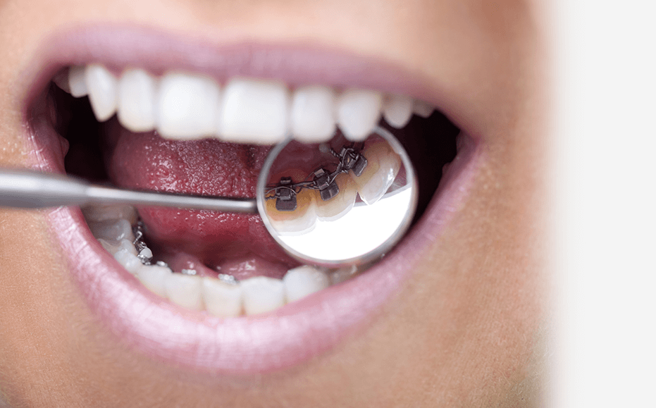 Lingual braces