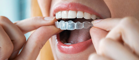  Invisalign® treatment