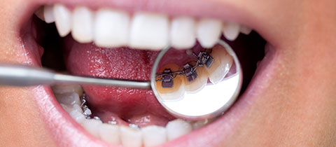 Incognito™ lingual braces