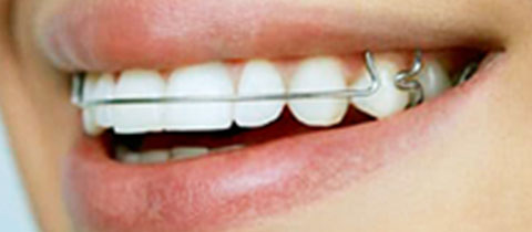 Retainers