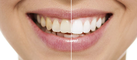 Tooth whitening